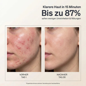 LUMISOL Mask - VYNEA™